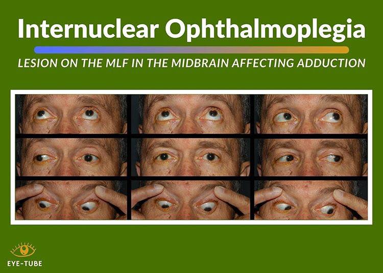 Internuclear Ophthalmoplegia Bilateral Internuclear Ophthalmoplegia In