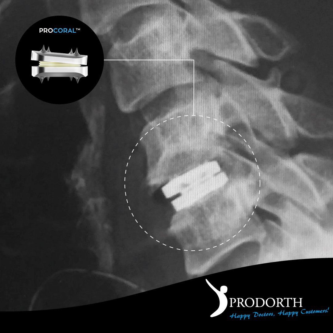 Prodorth Spine - 🎯 Anterior Cervical Disc Prosthesis 🎯...