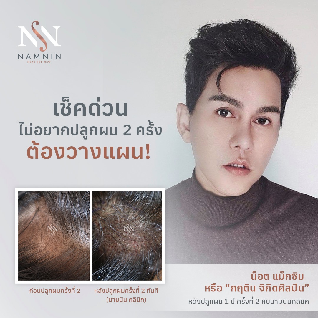 Namnin ForV clinic ปลูกผมถาวรเทคนิค NEAT โดยแพทย์ทุกกราฟ - การปลูกผม ...