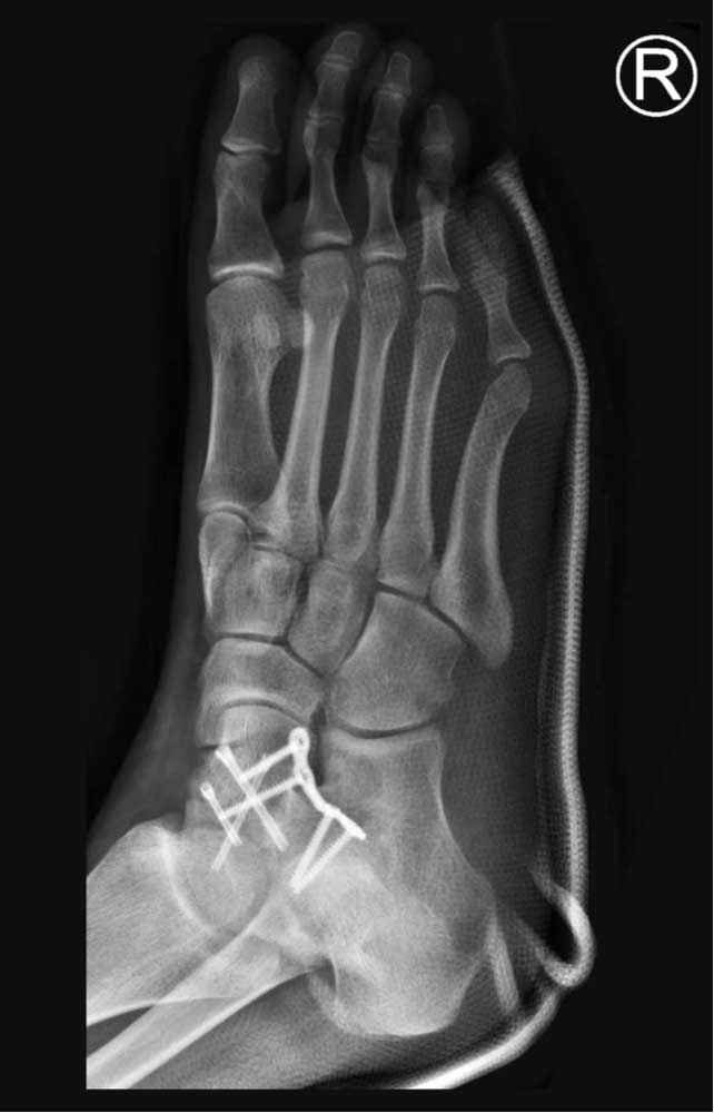 C. Thomas Haytmanek, MD & Jonathon Backus, MD - Sports Foot & Ankle ...