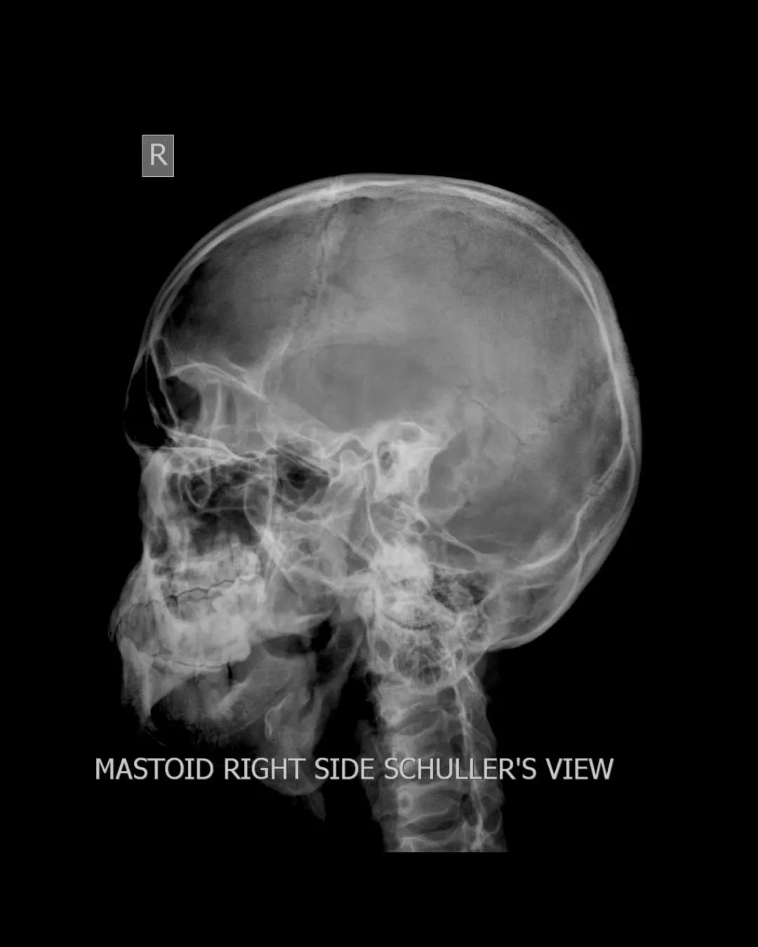 ⚕️ Mastoid Schuller's View X-Ray... - Medical Radiologia