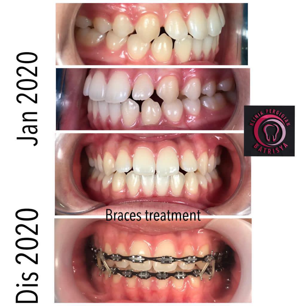 Perubahan BEFORE & AFTER pakai... - Klinik Pergigian Batrisya