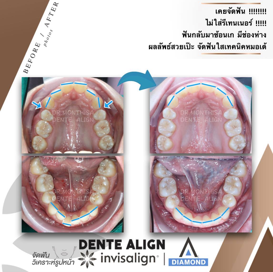 เคยจัดฟั... - Dente Align Clinic - Invisalign Diamond Provider | Facebook
