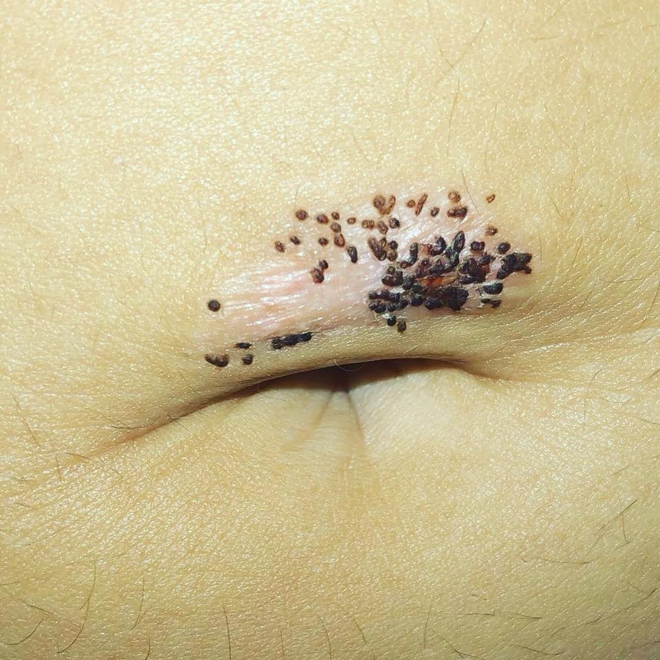 Belly Button Piercing Ripped Through Skin