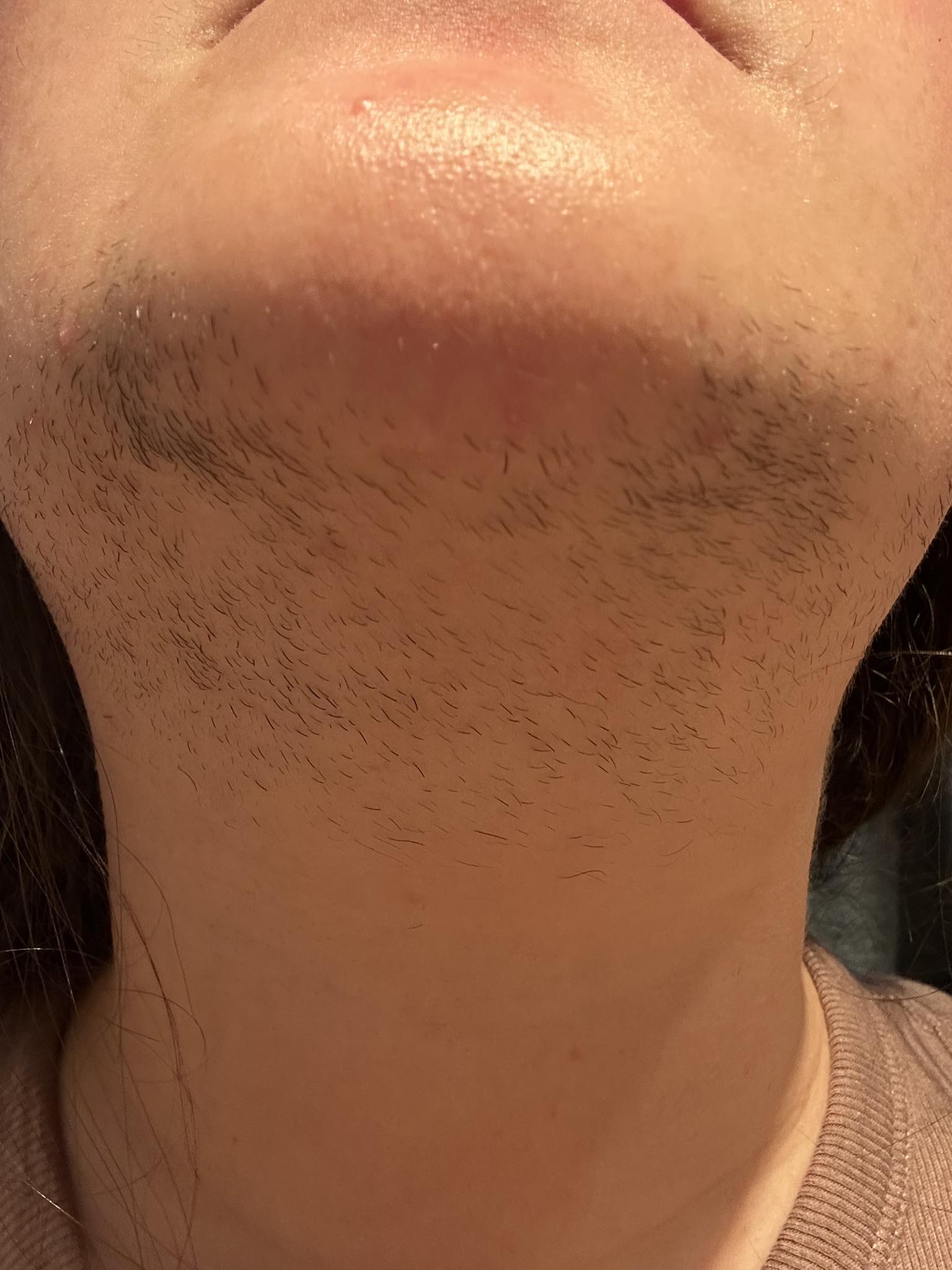 does glp 1 help with pcos facial hair Your Body Isn't Broken: How GLP-1 Medications Are Changing The Game For PCOS said: Here's a beard.