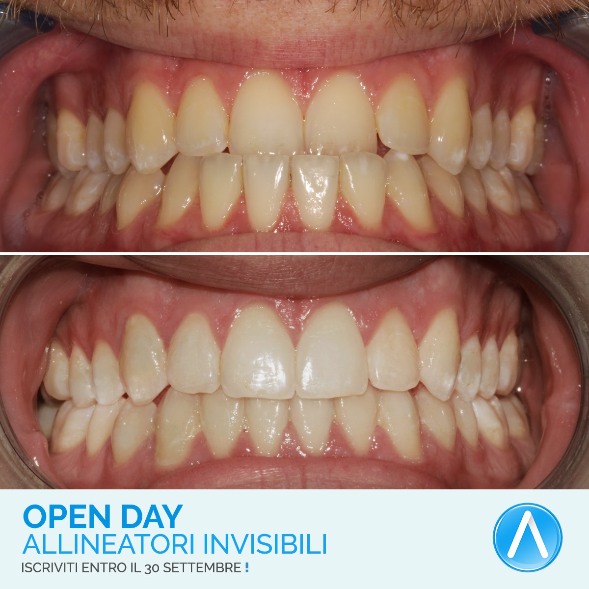 Soffri di morso inverso? Puoi... - ADC Advanced Dental Center | Facebook
