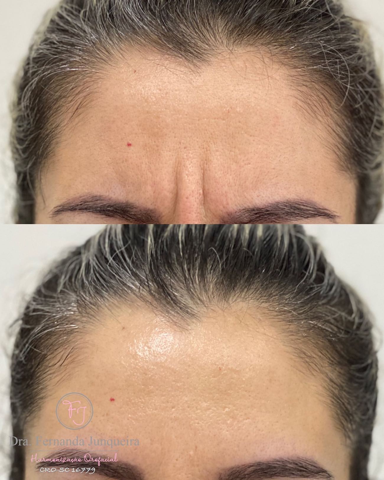Dra Fernanda Junqueira - Resultado da Toxina Botulínica na região da ...