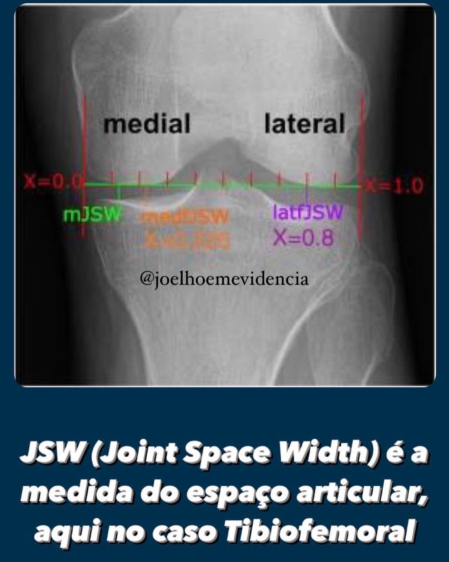 Explicação sobre JSW e sua relação... - Joelho em Evidência