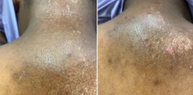Life with Scleroderma | Has anyone tried red light therapy for ...