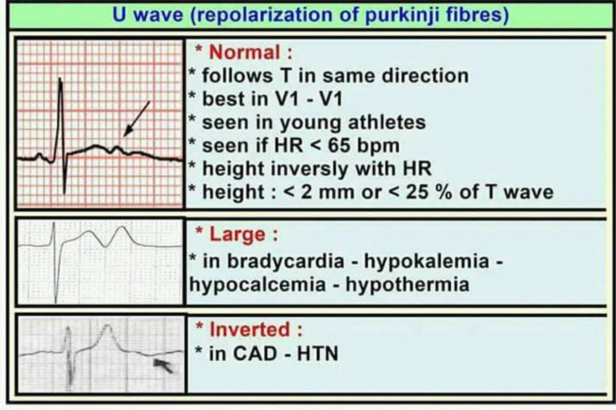 Promed Academy - What is U Wave?🧐 And when it is normal,... | Facebook