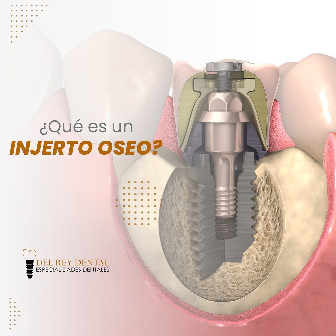 Del Rey Dental - ¿Qué es un Injerto óseo? Es un...