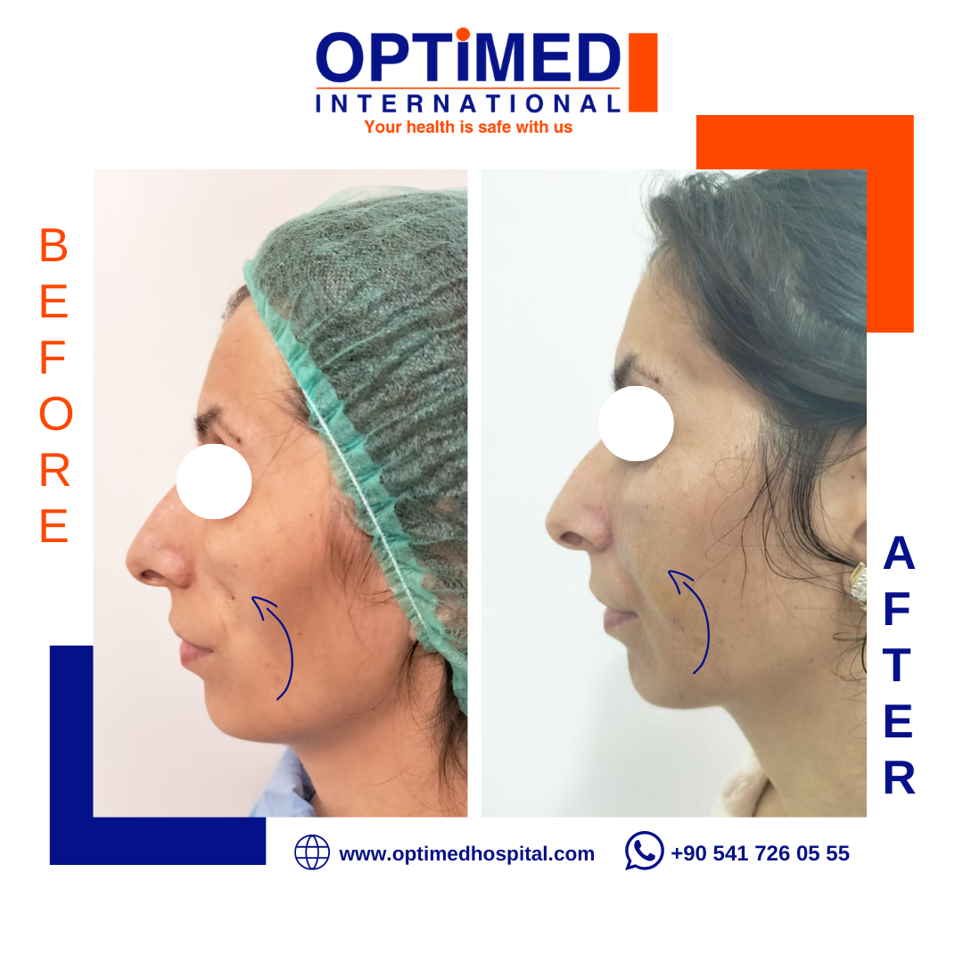 The result of the fat injection we... - Optimed Hospital