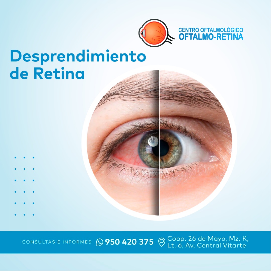 Centro - El desprendimiento de retina afecta aproximadamente a una de ...