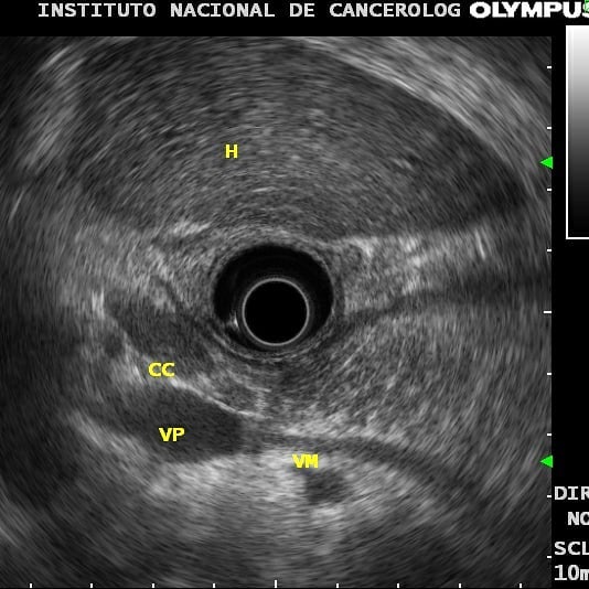 Endoscopiaplus - No todo son piedras ☄ . -Paciente de 78... | Facebook