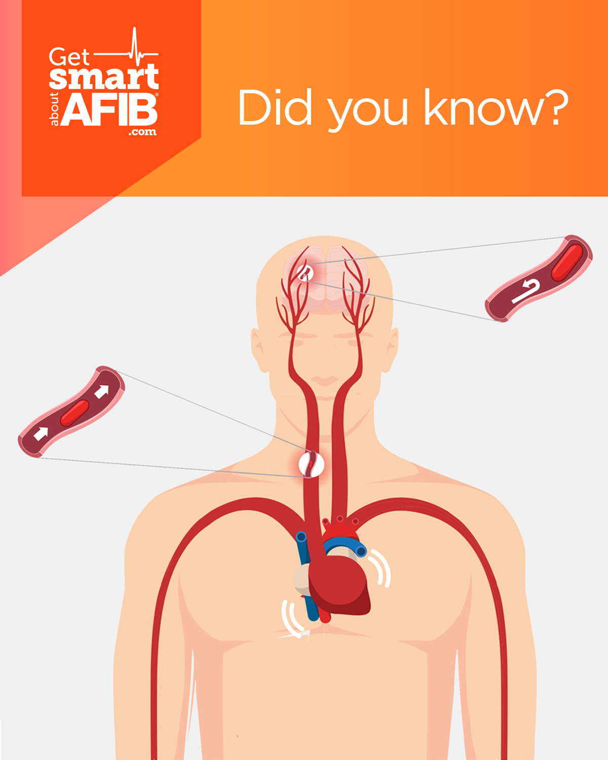 Get smart about afib did you know nearly of strokes are caused by