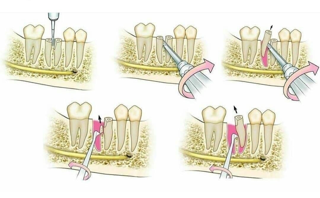 First molar extraction 👌 #how_to... - Nashawy Dentistry