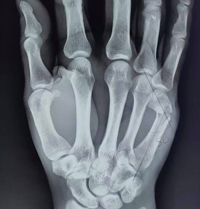 La fractura del cuello del... - Ciencias Médicas y Biológicas