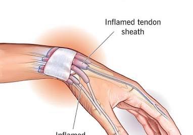 Eleonor - De Quervain's Tenosynovitis - OrthoInfo - AAOS Identifying ...