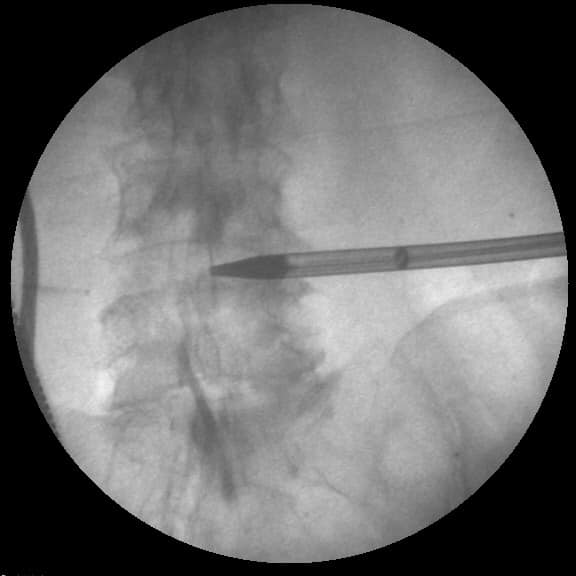 PSLD Spine Foundation India