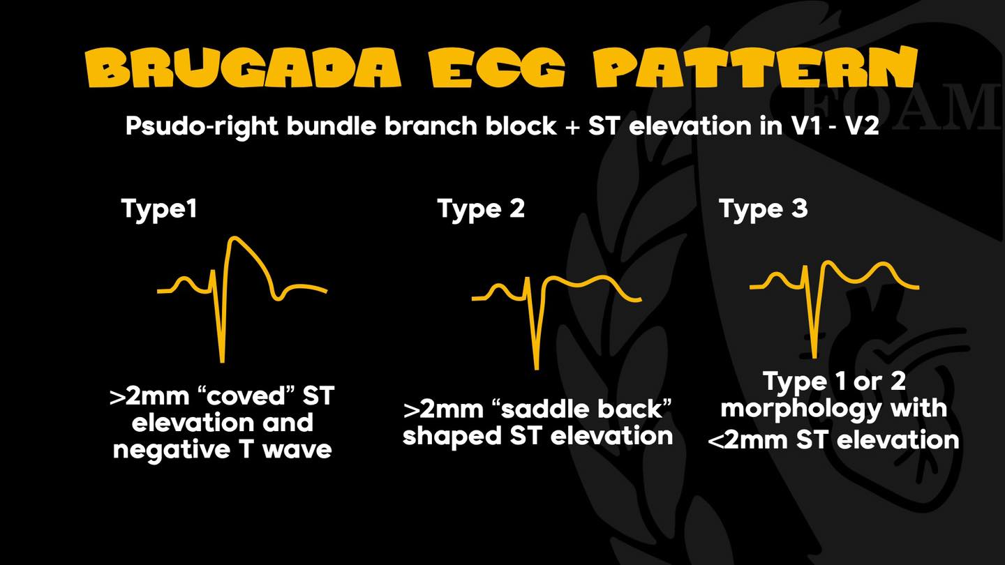 FOAMfrat - Brugada ECG Pattern Brugada ECG Pattern is not... | Facebook