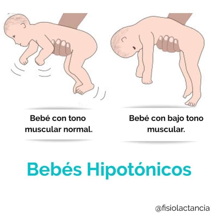 Descam - La Hipotonía es una disminución del tono...