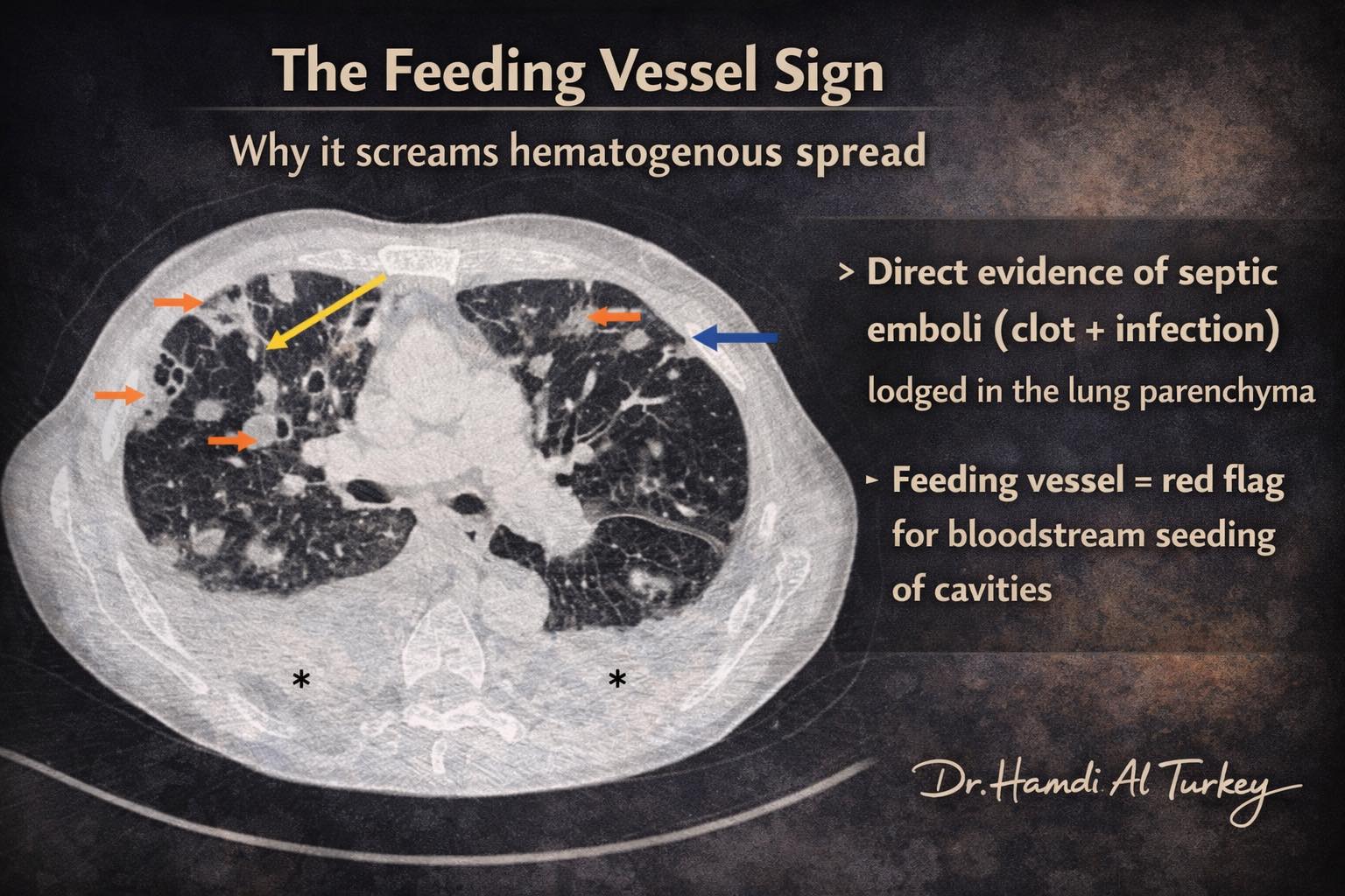 Hamdi Al-Turkey - The Feeding Vessel Sign → Why it screams... | Facebook