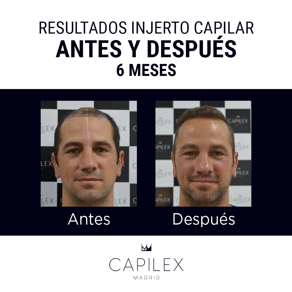 Capilex Madrid - ️ Es el momento perfecto para realizarse... | Facebook