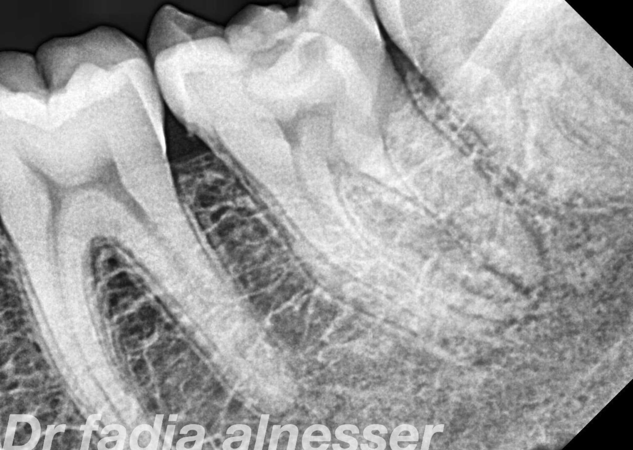 A case of RADIX ENTOMOLARIS 
