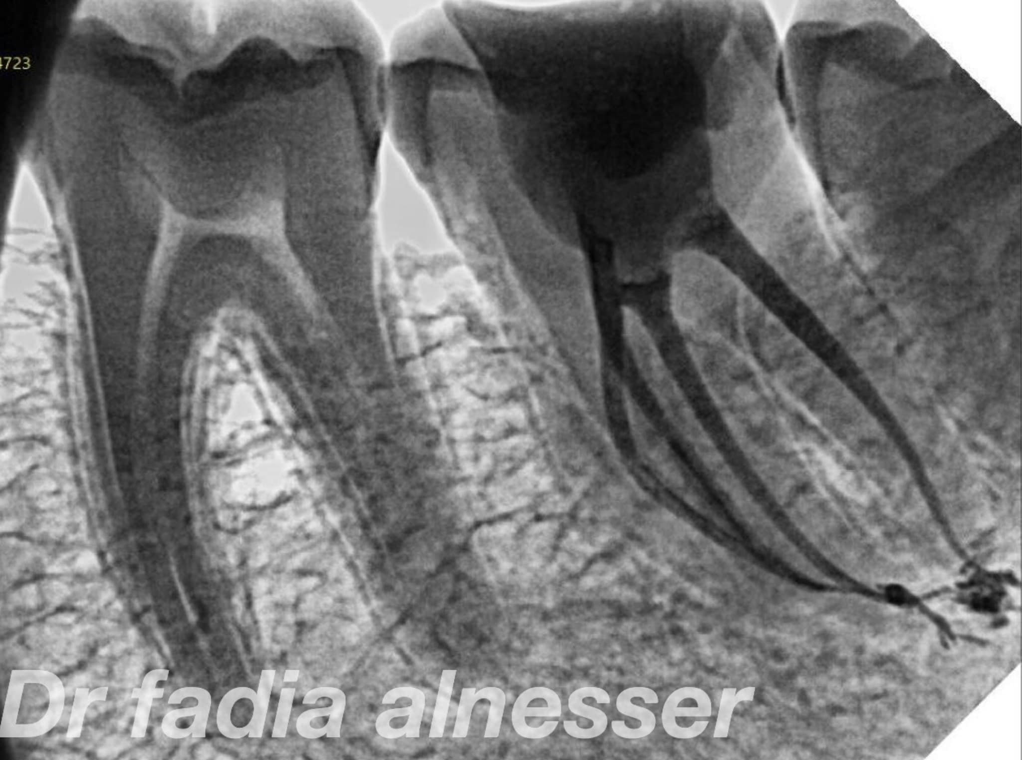 A case of RADIX ENTOMOLARIS 