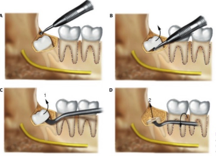 Dr. - Odontectomía de tercer molar en distoversión, osteotomía para ...
