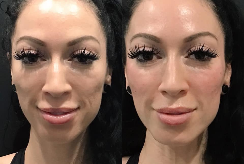 Infinity MedSpa - Ever thought about getting filler in...