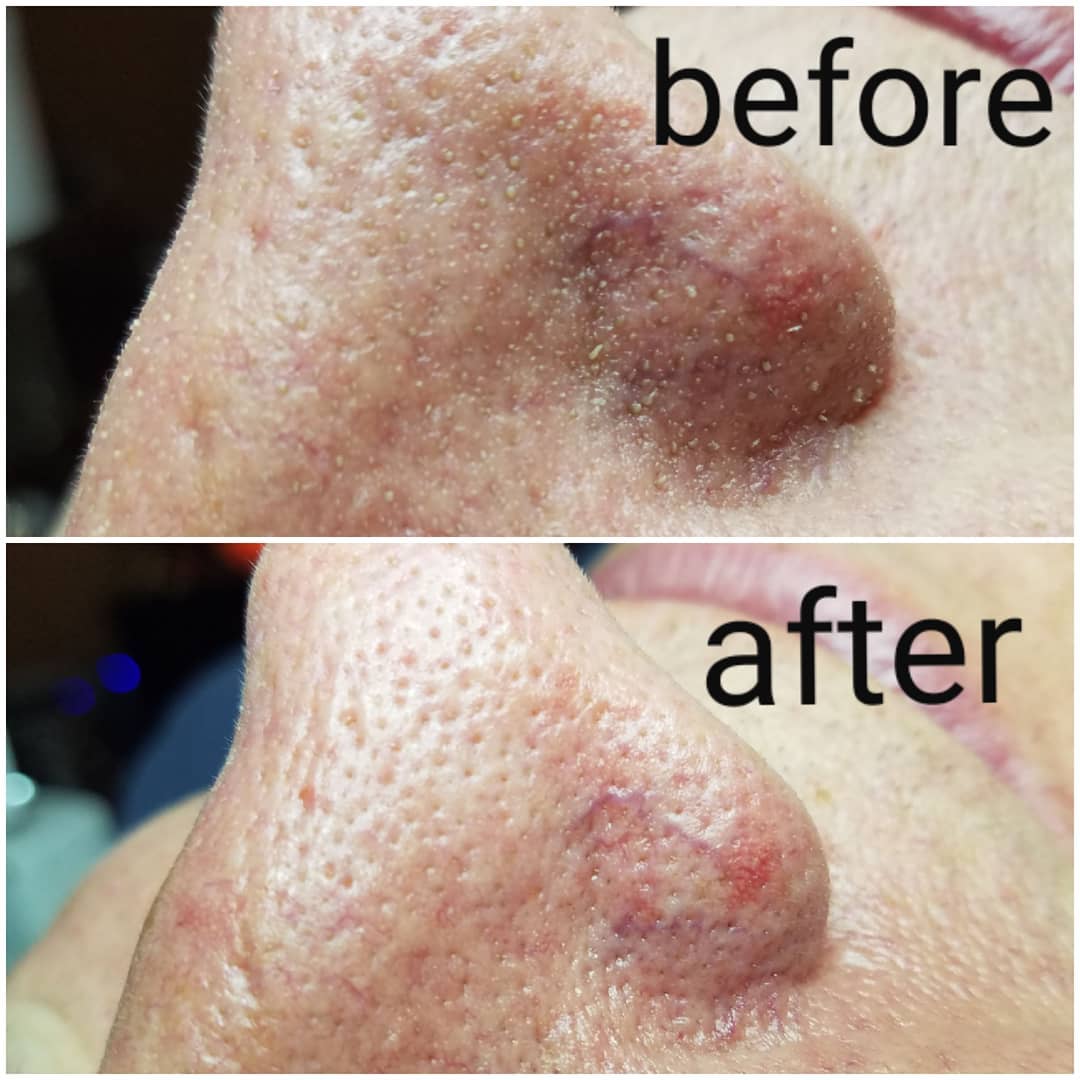 Opulent - Ultrasonic Dermasound: before & after. AMAZING RESULTS ...