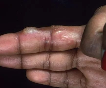 What is Whitlow and how is it treated?