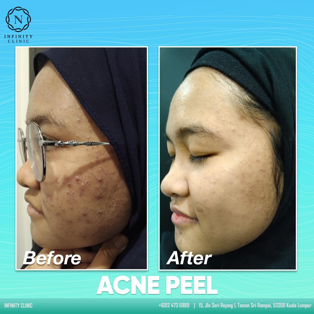BEFORE & AFTER ACNE PEEL 😍 ... - Infinity Clinic by Dr Nadz