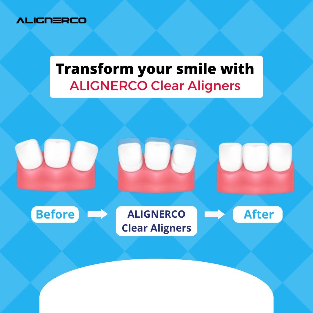 ALIGNERCO - Transform your smile today with AlignerCo Clear Aligners!🥰 ...