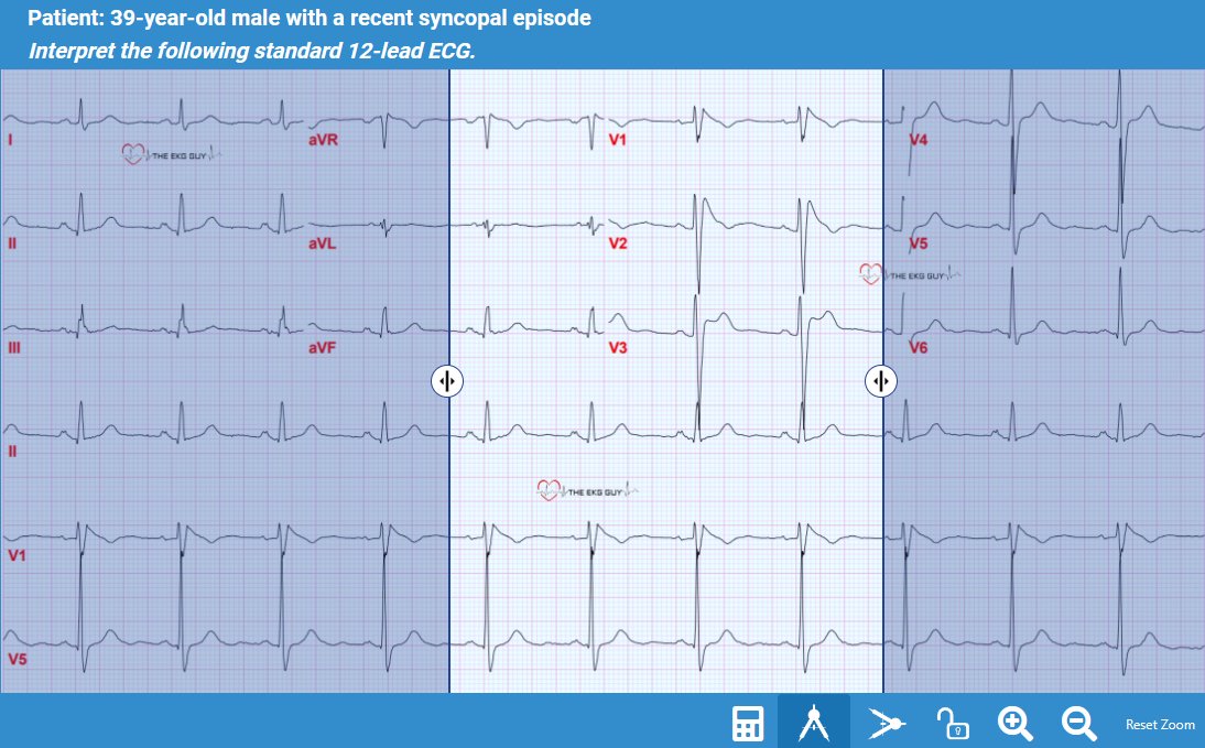 The EKG - ⚠️ Acute lateral myocardial injury pattern ⚠️ ECG criteria ...