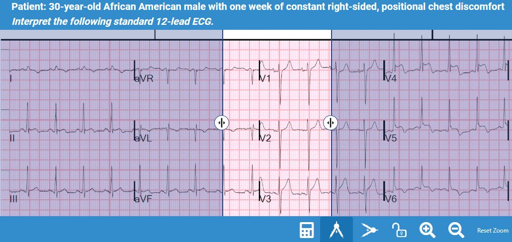 The EKG - ⚠️ Acute lateral myocardial injury pattern ⚠️ ECG criteria ...
