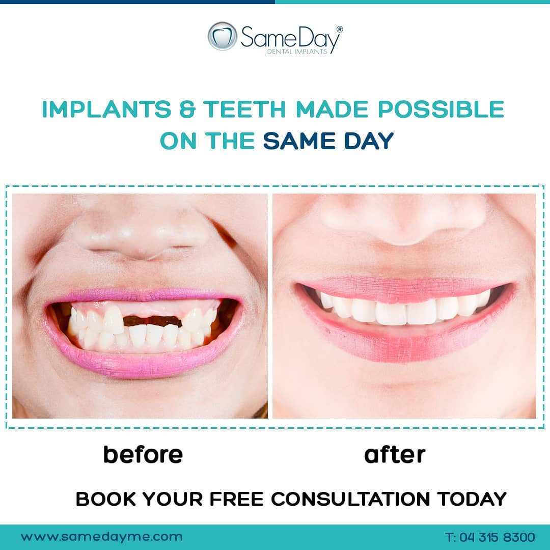 Sameday Dental Implants Startside Facebook