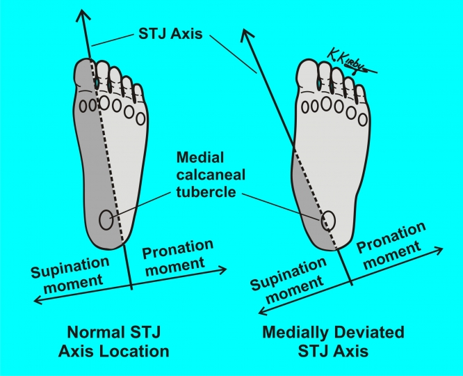 Subtalar Joint... - American College of Podiatric Medicine | Facebook