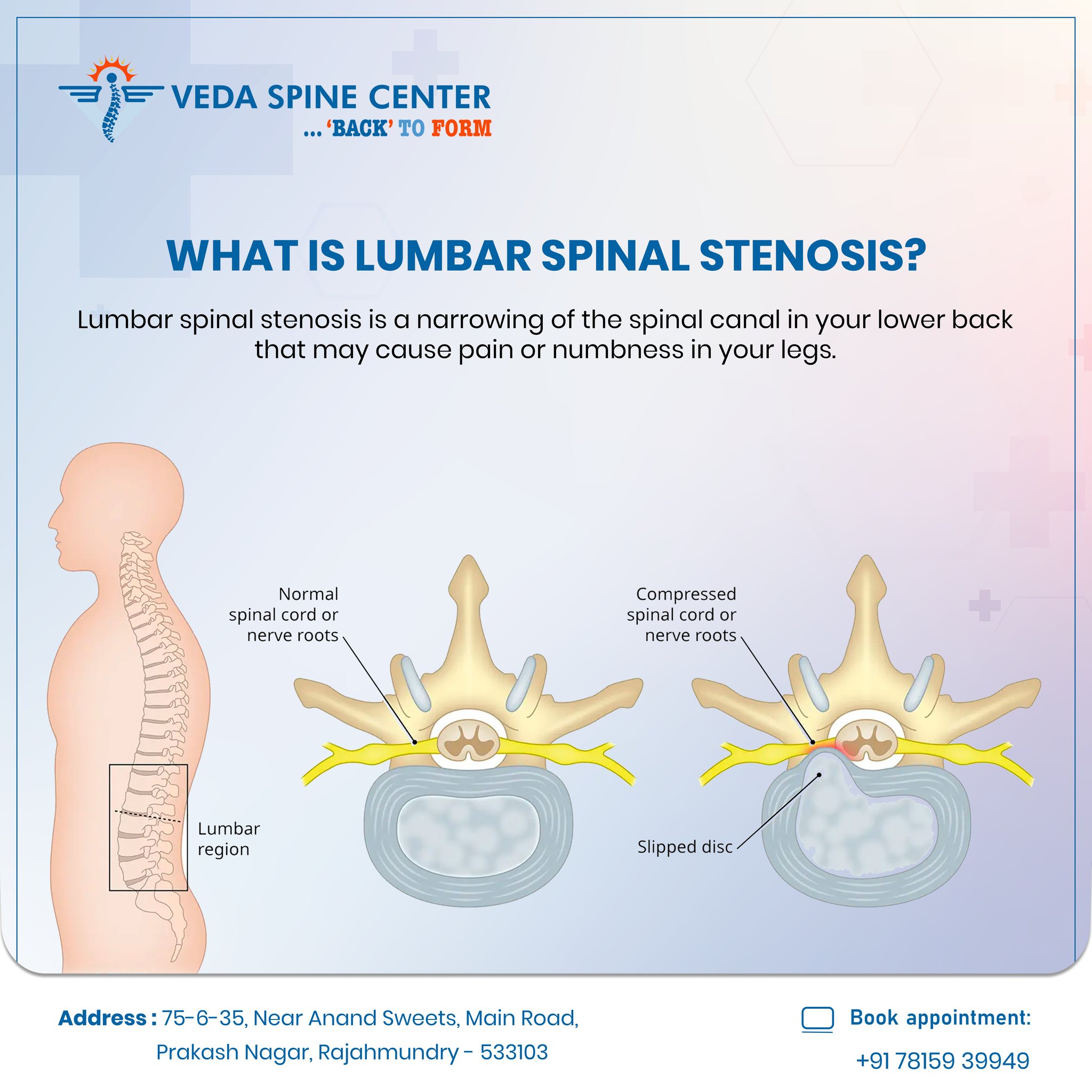 Dr - Lumbar spinal stenosis occurs when the spaces within the spine ...