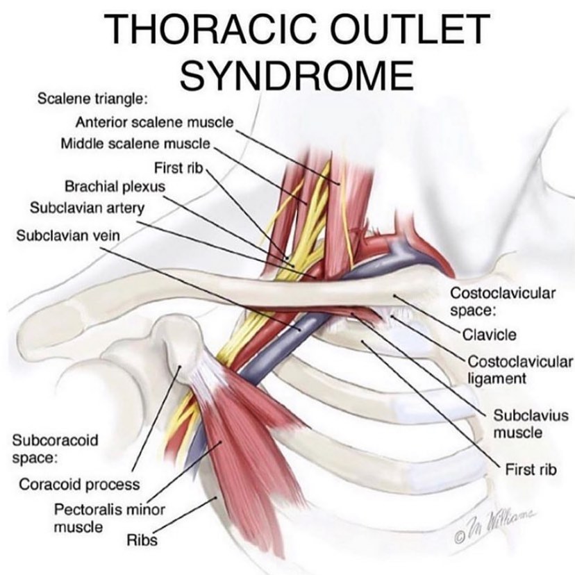 Momentum Therapies - Thoracic Outlet Syndrome (TOS) is a term used to ...
