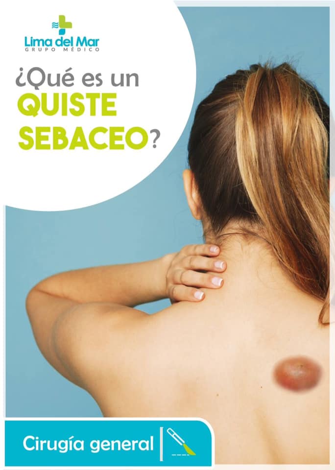 QUISTE SEBACEO: Son quistes benignos que crecen lentamente en el ...