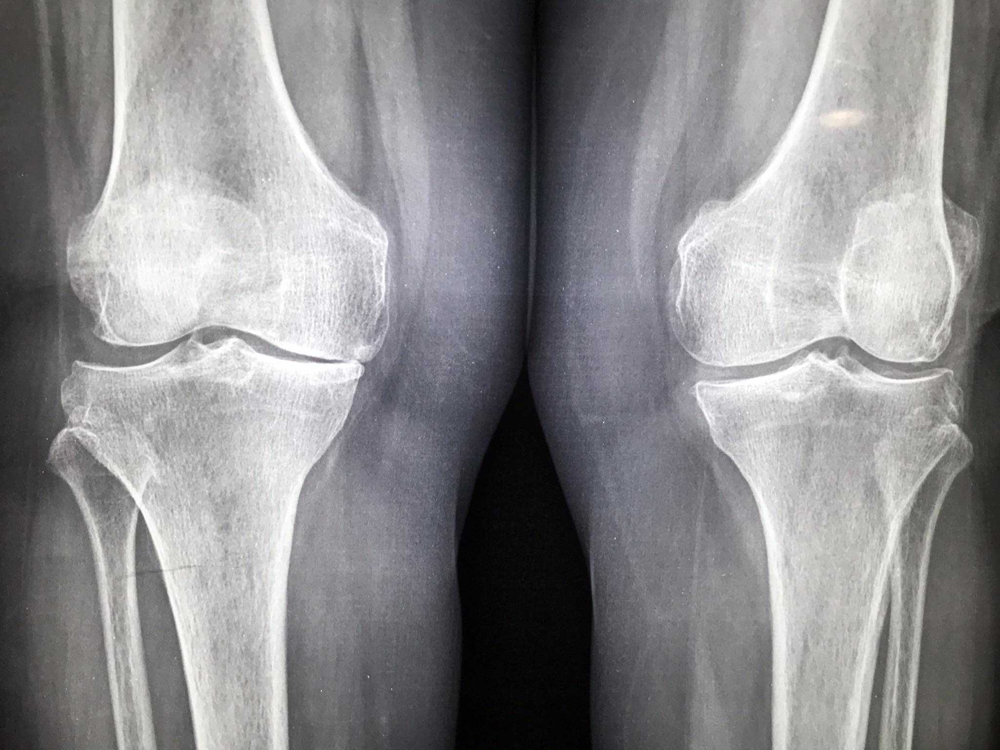 Gonartrosis derecha. Tratamiento. Prótesis total de rodilla derecha. No ...
