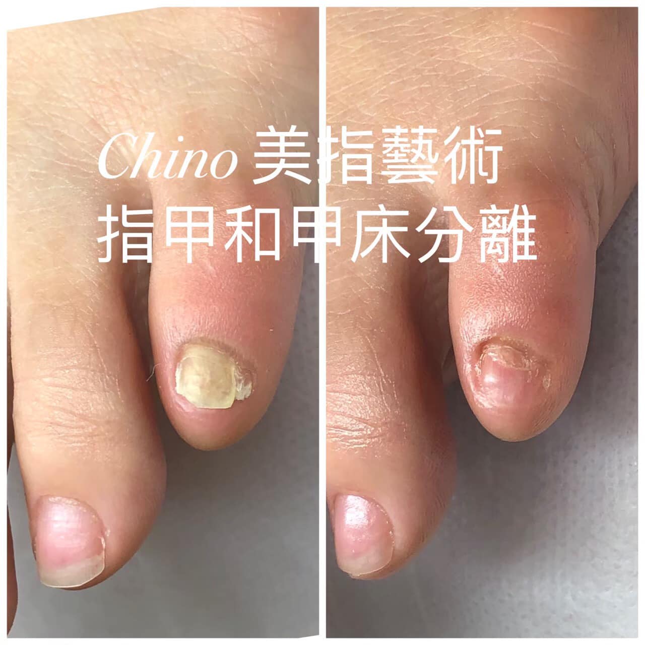 Chino美指藝術 指甲和甲床分離 指甲掏空好奇怪怎麼指甲變顏色了呢 我們的指甲 沒有這麼的強壯會因為我們不小心踢到撞到再加上不適合的鞋子 讓指甲產生變化 我們採用德國不侵入式的護理方式讓指甲開始健康的生長 灰指甲