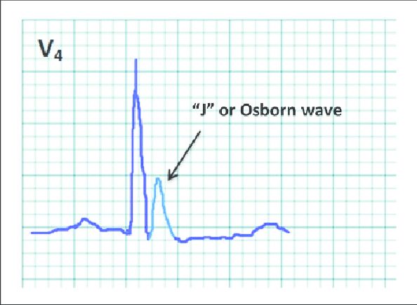 The J Wave (Osborn Wave): J wave, an extra deflection at the QRS