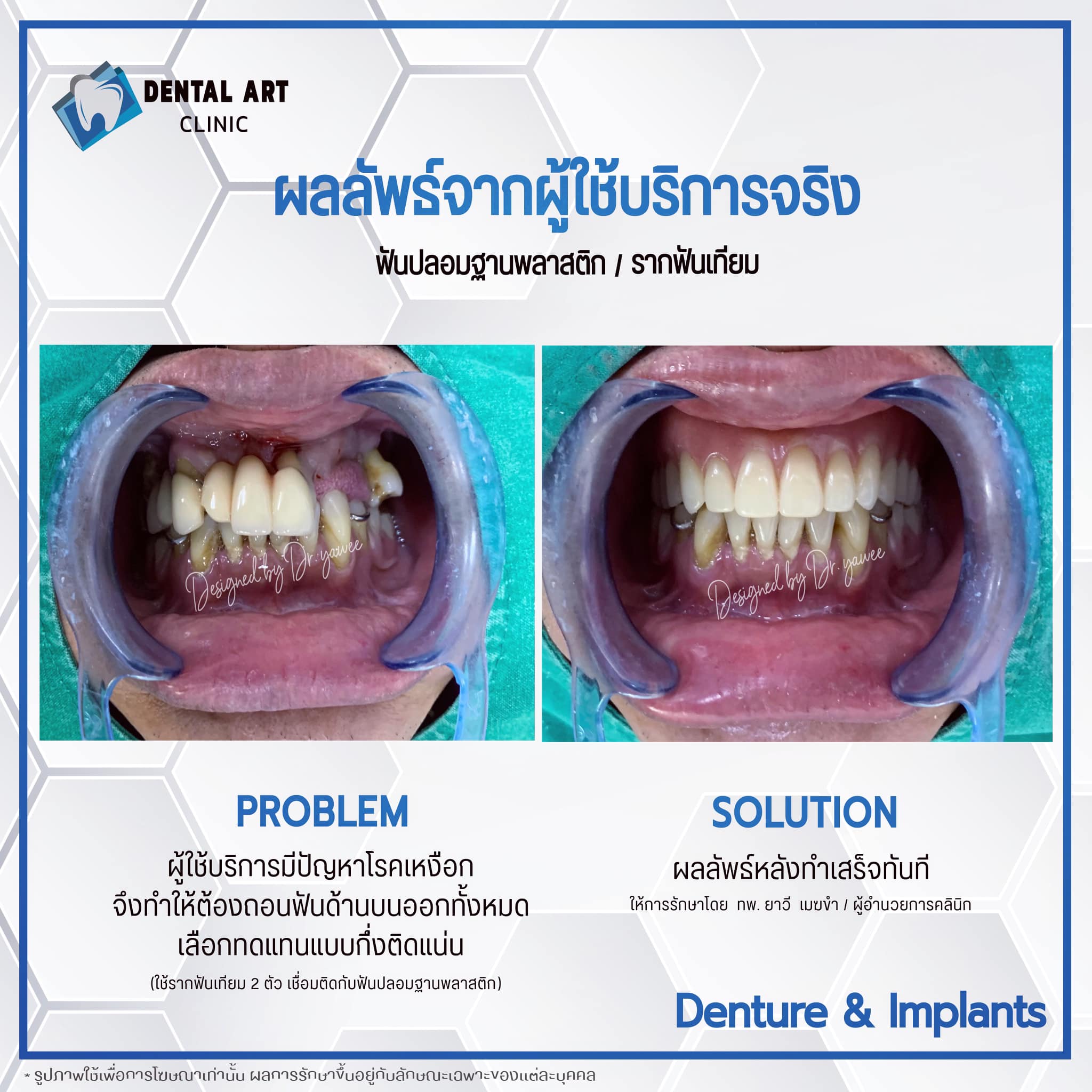 Dental - เพิ่มความมั่นใจให้กลับมาอีกครั้ง สำหรับผู้ที่สูญเสียฟันทั้ง ...