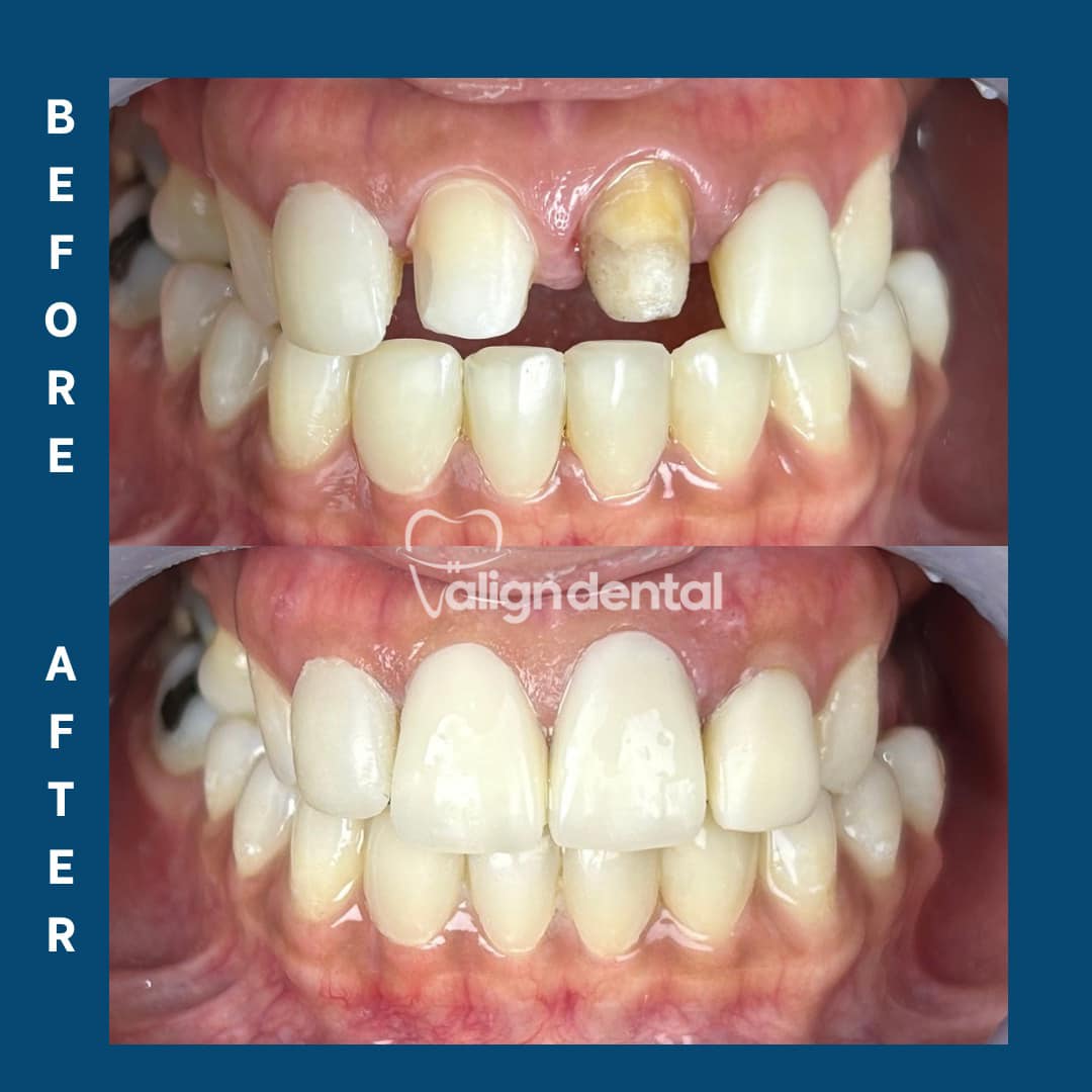 Happy Midweek everyone! 😊 RCT treated... - Align Dental PHL