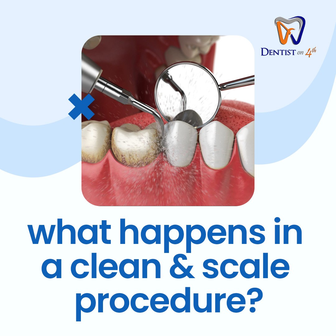 Dentist on 4th - What happens in a scale and clean... | Facebook