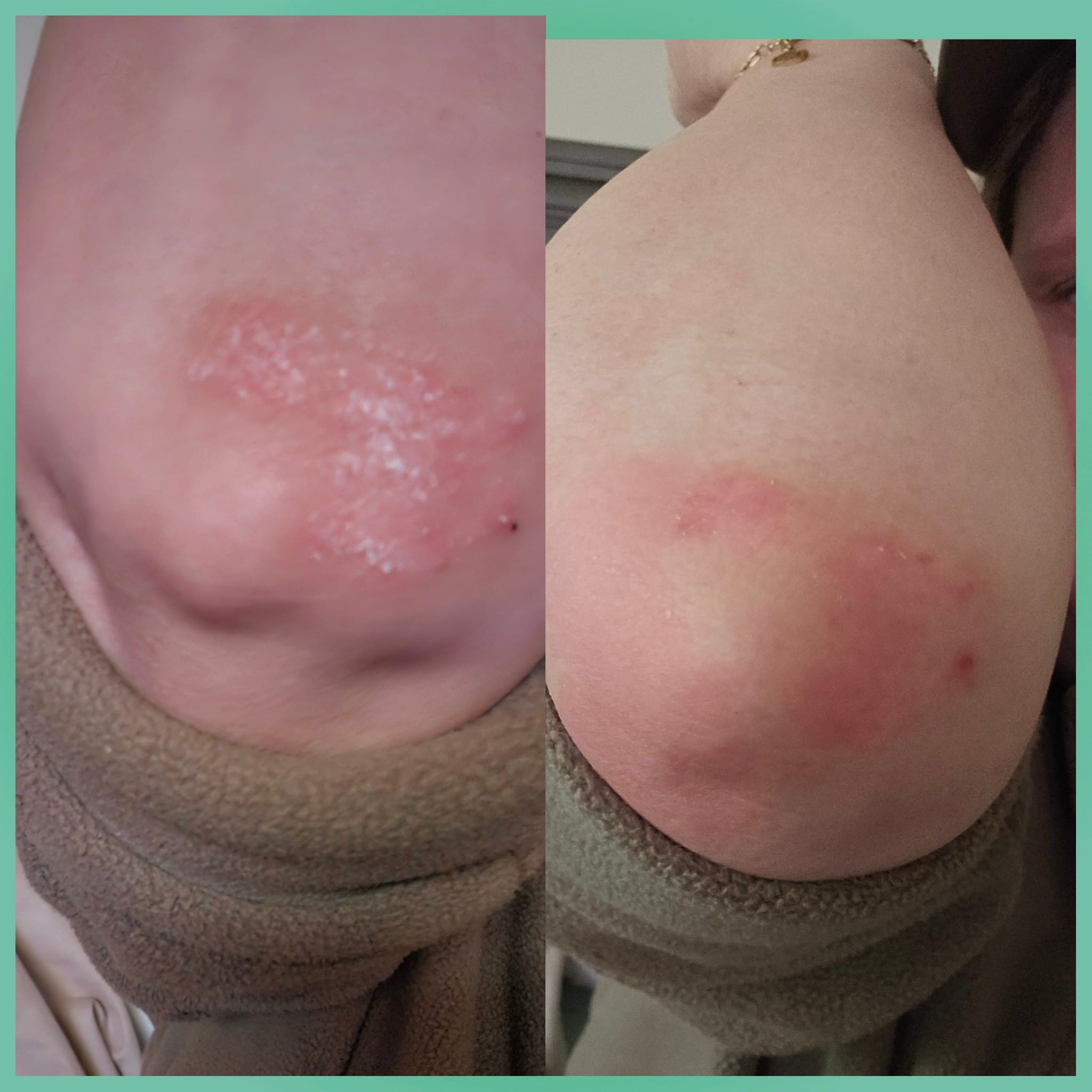 Glutazol injection lotion review
