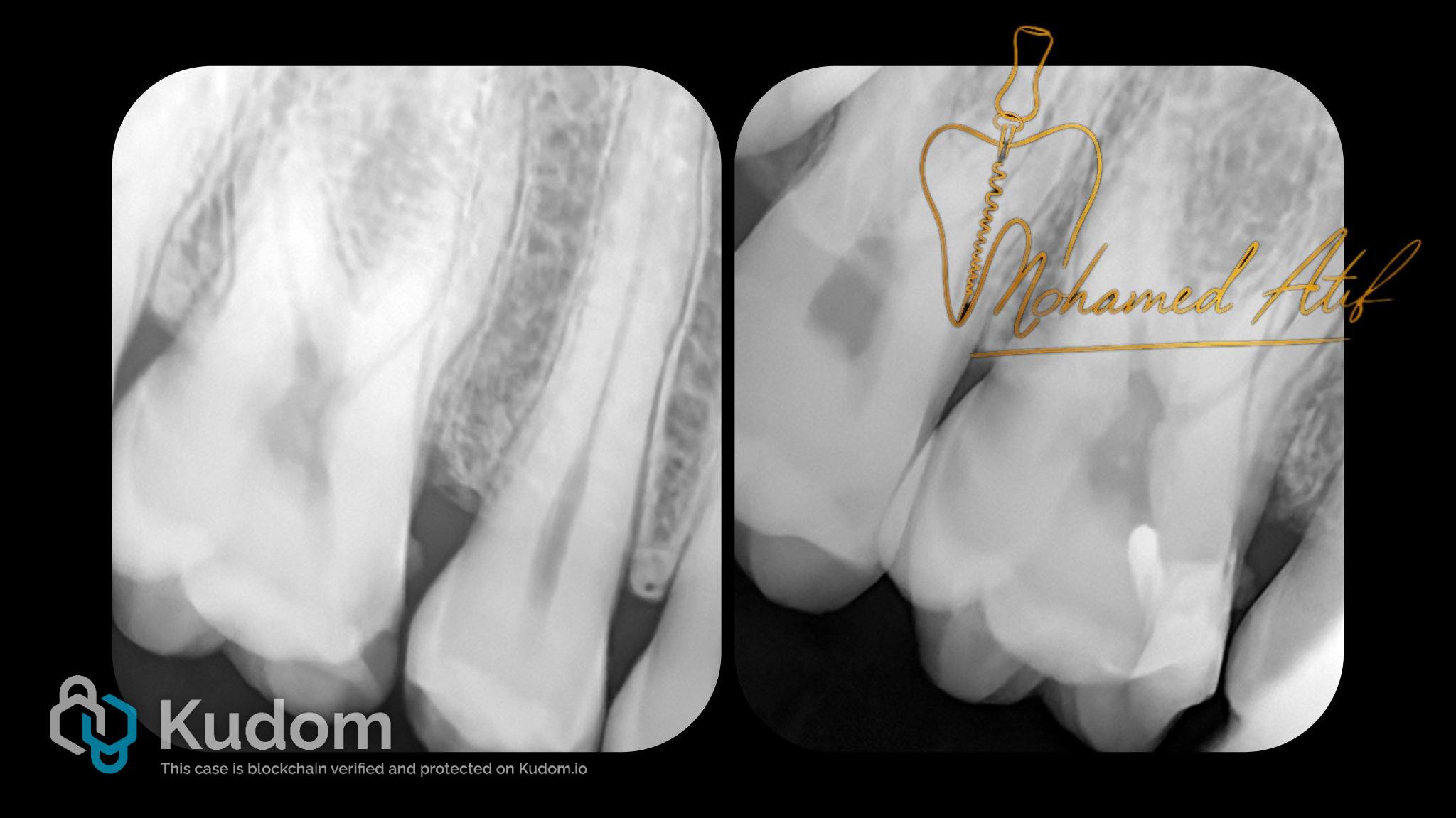 Vital Pulp Therapy for Tooth No. 16 with Bioceramic Putty